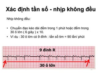 Nhịp không đều:
• Chuyển đạo kéo dài đếm trong 1 phút hoặc đếm trong
30 ô lớn ( 6 giây ) x 10.
• Ví dụ : 30 ô lớn có 9 đỉnh : tần số tim = 90 lần/ phút
30 ô lớn
9 đỉnh R
Xác định tần số - nhịp không đều
33
 