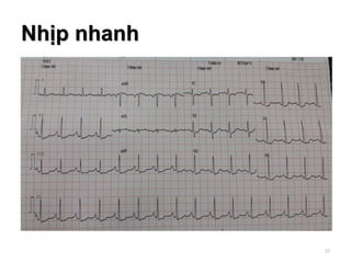 Nhịp nhanh
35
 