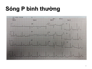 Sóng P bình thường
43
 