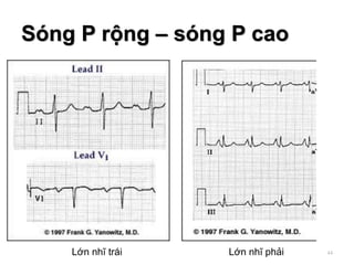 Sóng P rộng – sóng P cao
44Lớn nhĩ trái Lớn nhĩ phải
 