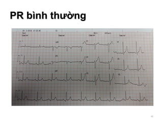 PR bình thường
48
 