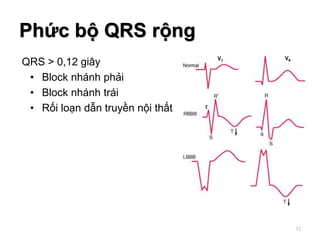 QRS > 0,12 giây
• Block nhánh phải
• Block nhánh trái
• Rối loạn dẫn truyền nội thất
Phức bộ QRS rộng
52
 