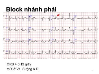 QRS > 0,12 giây
rsR’ ở V1, S rộng ở DI
Block nhánh phải
53
 