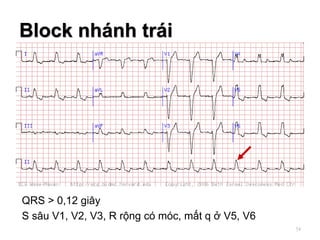 QRS > 0,12 giây
S sâu V1, V2, V3, R rộng có móc, mất q ở V5, V6
Block nhánh trái
54
 
