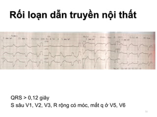 QRS > 0,12 giây
S sâu V1, V2, V3, R rộng có móc, mất q ở V5, V6
Rối loạn dẫn truyền nội thất
55
 