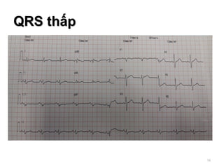 QRS thấp
58
 