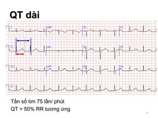Tần số tim 75 lần/ phút
QT > 50% RR tương ứng
QT dài
60
 