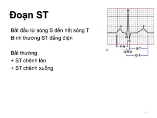 Bắt đầu từ sóng S đến hết sóng T
Bình thường ST đẳng điện
Bất thường
+ ST chênh lên
+ ST chênh xuống
Đoạn ST
61
 