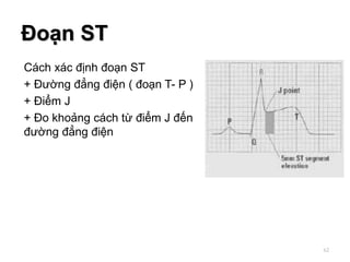 Cách xác định đoạn ST
+ Đường đẳng điện ( đoạn T- P )
+ Điểm J
+ Đo khoảng cách từ điểm J đến
đường đẳng điện
Đoạn ST
62
 