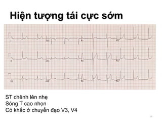 Hiện tượng tái cực sớm
ST chênh lên nhẹ
Sóng T cao nhọn
Có khấc ở chuyển đạo V3, V4
64
 