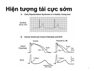 Hiện tượng tái cực sớm
65
 