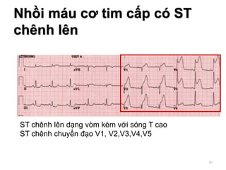 Nhồi máu cơ tim cấp có ST
chênh lên
ST chênh lên dạng vòm kèm với sóng T cao
ST chênh chuyển đạo V1, V2,V3,V4,V5
66
 
