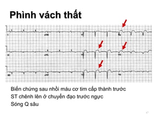 Biến chứng sau nhồi máu cơ tim cấp thành trước
ST chênh lên ở chuyển đạo trước ngực
Sóng Q sâu
Phình vách thất
67
 