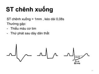 ST chênh xuống > 1mm , kéo dài 0,08s
Thường gặp:
- Thiếu máu cơ tim
- Thứ phát sau dày dãn thất
ST chênh xuống
69
 
