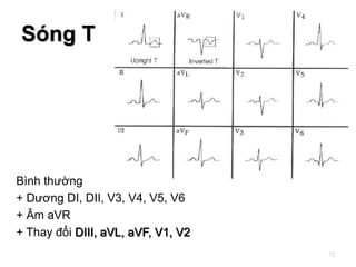 Bình thường
+ Dương DI, DII, V3, V4, V5, V6
+ Âm aVR
+ Thay đổi DIII, aVL, aVF, V1, V2
Sóng T
72
 