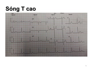 Sóng T cao
74
 