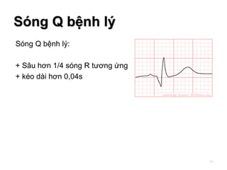 Sóng Q bệnh lý:
+ Sâu hơn 1/4 sóng R tương ứng
+ kéo dài hơn 0,04s
Sóng Q bệnh lý
77
 