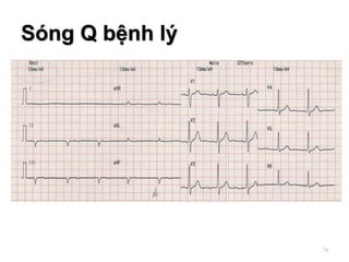 Sóng Q bệnh lý
78
 