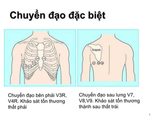 8
Chuyển đạo bên phải V3R,
V4R. Khảo sát tổn thương
thất phải
Chuyển đạo sau lưng V7,
V8,V9. Khảo sát tổn thương
thành sau thất trái
Chuyển đạo đặc biệt
8
 