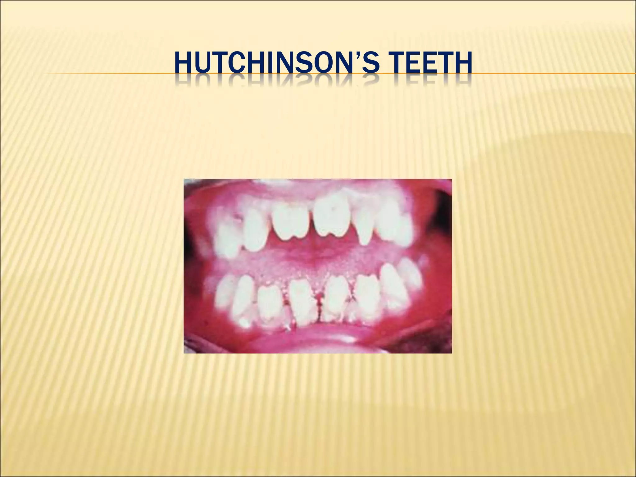 HUTCHINSON’S TEETH
 