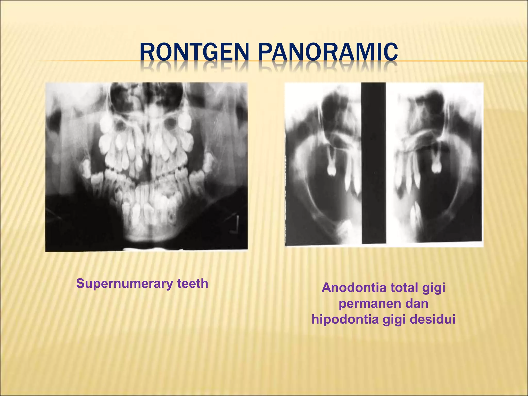RONTGEN PANORAMIC
Supernumerary teeth Anodontia total gigi
permanen dan
hipodontia gigi desidui
 