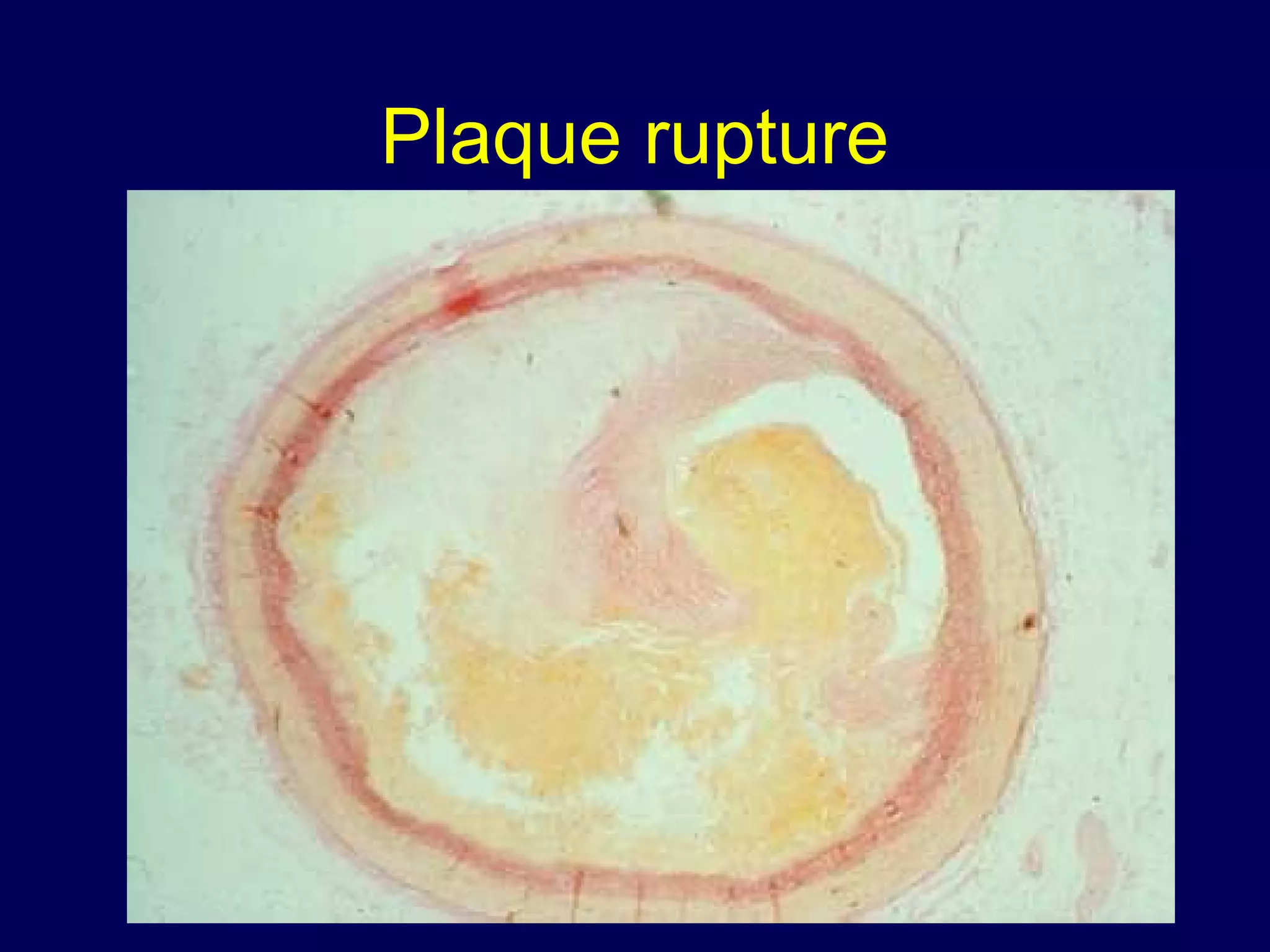Plaque rupture
 