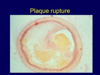 Plaque rupture
 