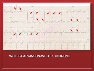 WOLFF-PARKINSON-WHITE SYNDROME
 