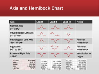Axis and Hemibock Chart
Axis Lead I Lead II Lead III Notes
Normal Axis
0° to 90°
Physiological Left Axis
0° to -40°
Pathological Left Axis
-40° to -90°
Anterior
Hemiblock
Right Axis
90° to 180°
Posterior
Hemiblock
Extreme Right Axis
>180°
Ventricular in
origin
 