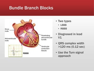 Bundle Branch Blocks
▪ Two types
▪ LBBB
▪ RBBB
▪ Diagnosed in lead
V1
▪ QRS complex width
>120 ms (0.12 sec)
▪ Use the Turn signal
approach
 