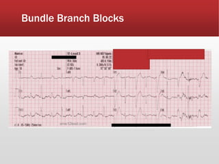 Bundle Branch Blocks
 