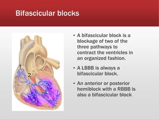 Bifascicular blocks
▪ A bifascicular block is a
blockage of two of the
three pathways to
contract the ventricles in
an organized fashion.
▪ A LBBB is always a
bifascicular block.
▪ An anterior or posterior
hemiblock with a RBBB is
also a bifascicular block
 