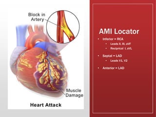 AMI Locator
• Inferior = RCA
• Leads II, III, aVF
• Reciprical I, aVL
• Septal = LAD
• Leads V1, V2
• Anterior = LAD
 