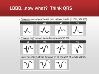 LBBB…now what? Think QRS
▪ Q waves seen in at least two lateral leads (I, aVL, V5, V6)
▪ R wave regression seen from leads V1-V4
▪ Late notching of the S wave in at least 2 of leads V3-V5
I aVL V5 V6
V1 V2 V3 V4
 
