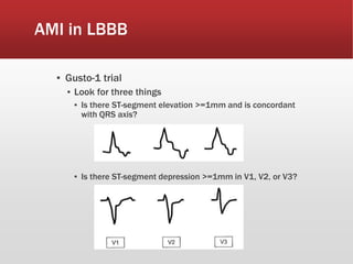 AMI in LBBB
▪ Gusto-1 trial
▪ Look for three things
▪ Is there ST-segment elevation >=1mm and is concordant
with QRS axis?
▪ Is there ST-segment depression >=1mm in V1, V2, or V3?
 