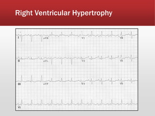 Right Ventricular Hypertrophy
 