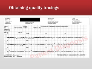 Obtaining quality tracings
 