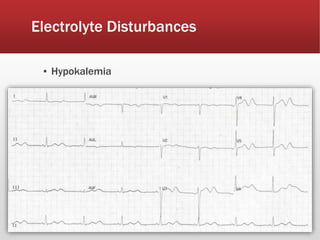 Electrolyte Disturbances
▪ Hypokalemia
 