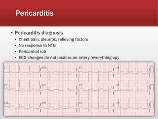 Pericarditis
▪ Pericarditis diagnosis
▪ Chest pain, pleuritic, relieving factors
▪ No response to NTG
▪ Pericardial rub
▪ ECG changes do not localize an artery (everything up)
 