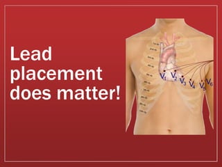 Lead
placement
does matter!
 