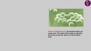 Picture of Staphylococci, the bacteria which can
cause acne. The scale of the image is indicated
by the line at top left, which is 5 micrometres
long.
 