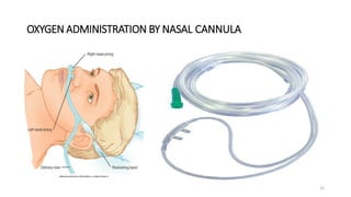 OXYGEN ADMINISTRATION BY NASAL CANNULA
15
 