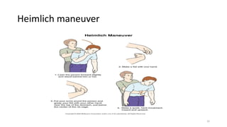 Heimlich maneuver
32
 