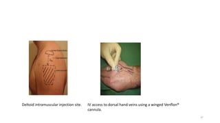 Deltoid intramuscular injection site. IV access to dorsal hand veins using a winged Venflon®
cannula.
37
 