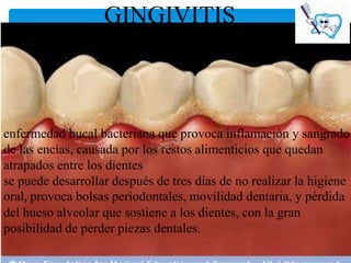 GINGIVITIS



enfermedad bucal bacteriana que provoca inflamación y sangrado
de las encías, causada por los restos alimenticios que quedan
atrapados entre los dientes
se puede desarrollar después de tres días de no realizar la higiene
oral, provoca bolsas periodontales, movilidad dentaria, y pérdida
del hueso alveolar que sostiene a los dientes, con la gran
posibilidad de perder piezas dentales.
 