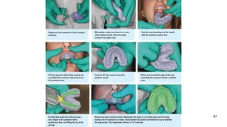 Fixed Impression Impression Techniques used for fixed partial Denture | PPTX
