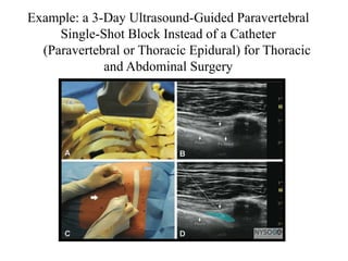 Example: a 3-Day Ultrasound-Guided Paravertebral
Single-Shot Block Instead of a Catheter
(Paravertebral or Thoracic Epidural) for Thoracic
and Abdominal Surgery
 