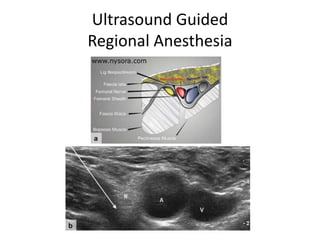 Ultrasound Guided
Regional Anesthesia
 