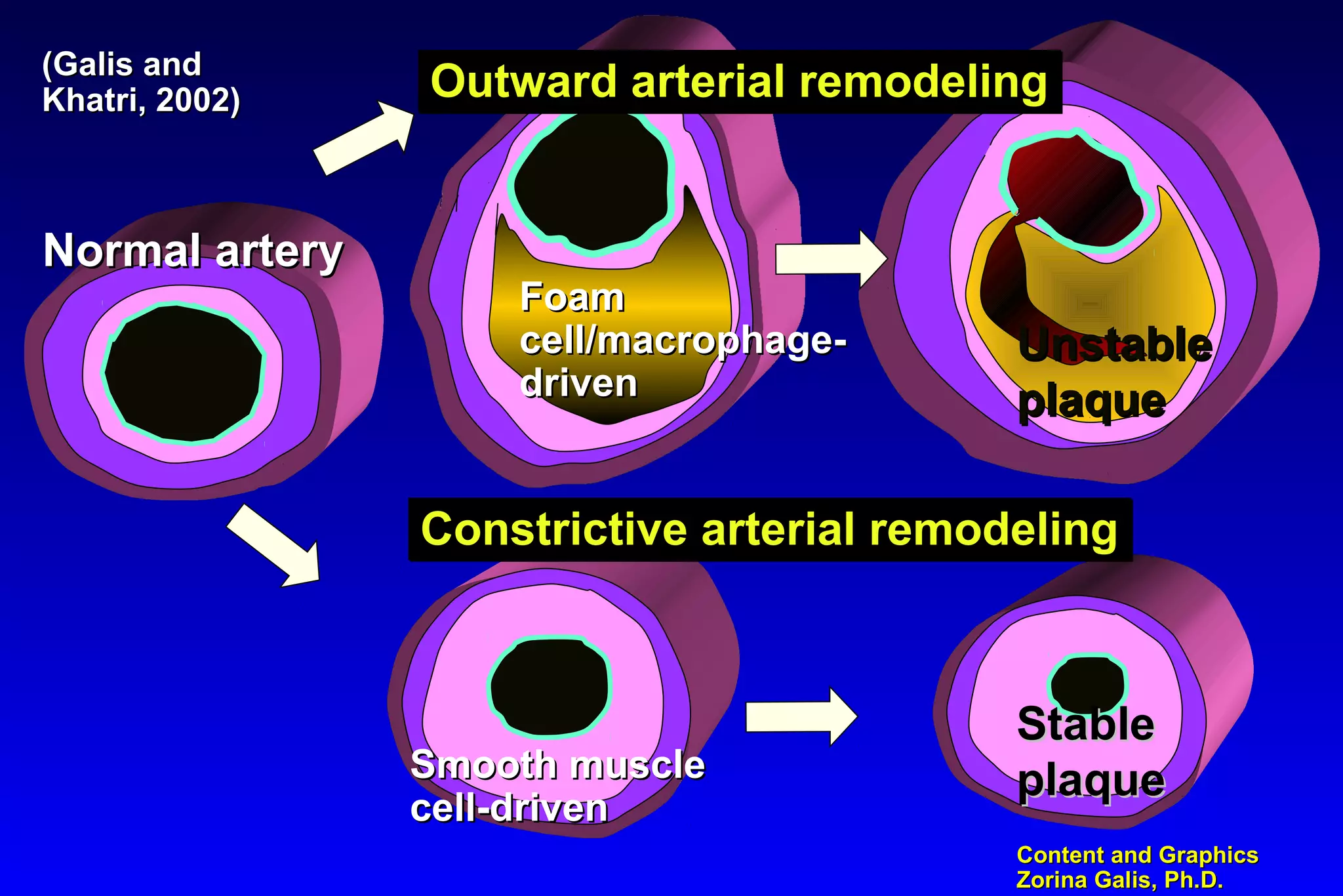 Content and GraphicsContent and Graphics
Zorina Galis, Ph.D.Zorina Galis, Ph.D.
FoamFoam
cell/macrophage-cell/macrophage-
drivendriven
Smooth muscleSmooth muscle
cell-drivencell-driven
UnstableUnstable
plaqueplaque
StableStable
plaqueplaque
Constrictive arterial remodelingConstrictive arterial remodeling
Outward arterial remodelingOutward arterial remodeling(Galis and(Galis and
Khatri, 2002)Khatri, 2002)
Normal arteryNormal artery
 