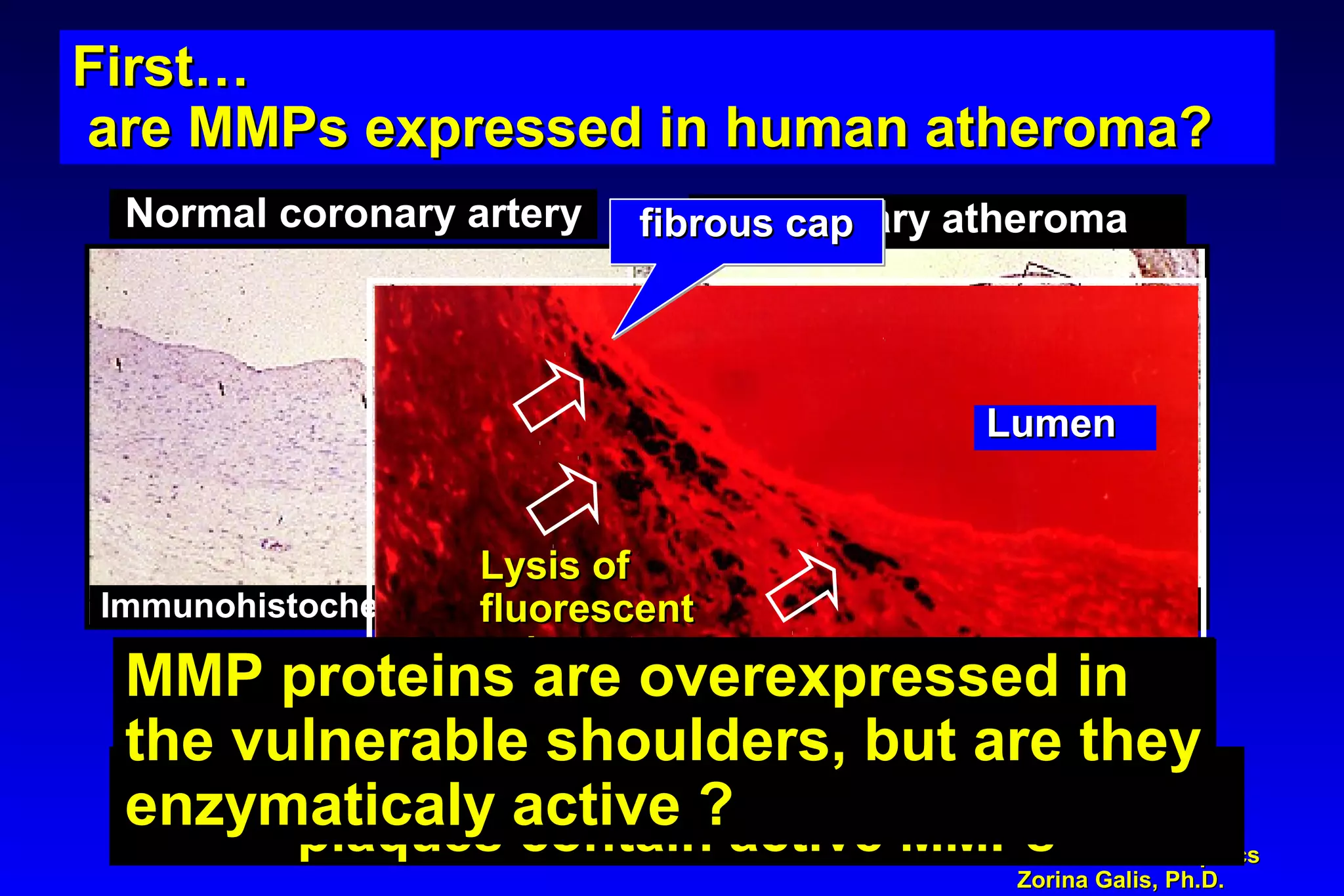 Content and GraphicsContent and Graphics
Zorina Galis, Ph.D.Zorina Galis, Ph.D.
Galis et al. 1994, JCIGalis et al. 1994, JCI
Normal coronary arteryNormal coronary artery Coronary atheromaCoronary atheroma
Immunohistochemistry: MMP-3Immunohistochemistry: MMP-3 Immuhistochemistry:Immuhistochemistry: MMP-3MMP-3
LumenLumen
fibrous capfibrous cap
In situIn situ zymography (activity assay)zymography (activity assay)In situIn situ zymography (activity assay)zymography (activity assay)
Lysis ofLysis of
fluorescentfluorescent
substratesubstrate
First…First…
are MMPs expressed in human atheroma?are MMPs expressed in human atheroma?
First…First…
are MMPs expressed in human atheroma?are MMPs expressed in human atheroma?
The shoulders of human atherosclerotic
plaques contain active MMPs
MMP proteins are overexpressed in
the vulnerable shoulders, but are they
enzymaticaly active ?
MMP proteins are overexpressed in
the vulnerable shoulders, but are they
enzymaticaly active ?
 
